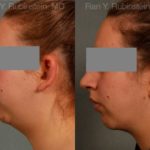 Chin Augmentation Before and After Photos in Newburgh, NY, Patient 12379