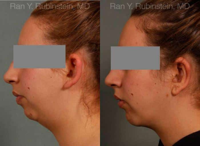 Chin Augmentation Before and After Photos in Newburgh, NY, Patient 12379