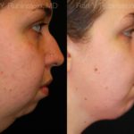 Chin Augmentation Before and After Photos in Newburgh, NY, Patient 12389