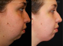 Chin Augmentation Before and After Photos in Newburgh, NY, Patient 12389