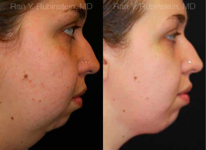 Chin Augmentation Before and After Photos in Newburgh, NY, Patient 12389