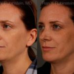 Chin Augmentation Before and After Photos in Newburgh, NY, Patient 12409