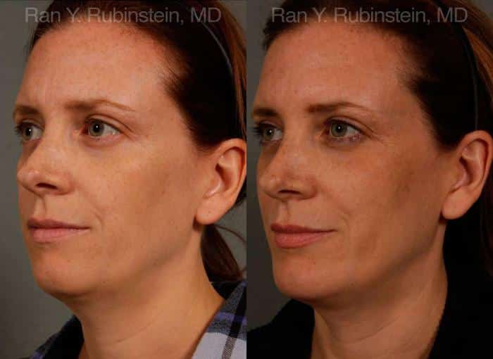 Chin Augmentation Before and After Photos in Newburgh, NY, Patient 12409