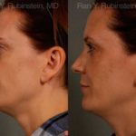 Chin Augmentation Before and After Photos in Newburgh, NY, Patient 12409