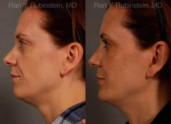 Chin Augmentation Before and After Photos in Newburgh, NY, Patient 12409