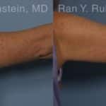 Coolsculpting Elite Before and After Photos in Newburgh, NY, Patient 12414