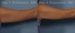 Coolsculpting Elite Before and After Photos in Newburgh, NY, Patient 12414