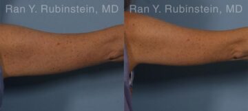 Coolsculpting Elite Before and After Photos in Montvale, NJ, Patient 12414