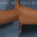 Coolsculpting Elite Before and After Photos in Newburgh, NY, Patient 12414