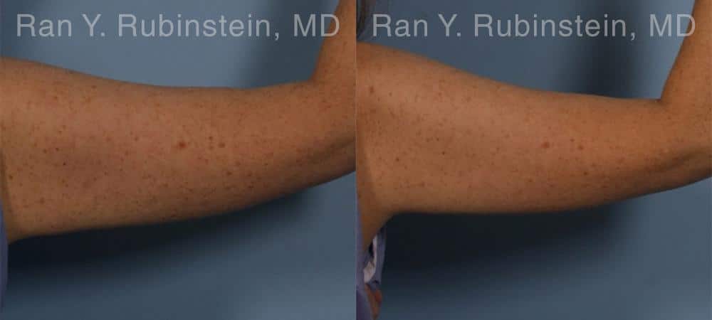 Coolsculpting Elite Before and After Photos in Newburgh, NY, Patient 12414