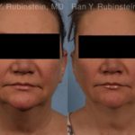 Coolsculpting Elite Before and After Photos in Newburgh, NY, Patient 12419