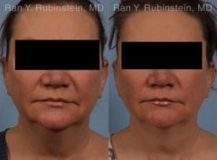 Coolsculpting Elite Before and After Photos in Newburgh, NY, Patient 12419