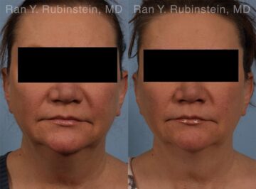 Coolsculpting Elite Before and After Photos in Montvale, NJ, Patient 12419