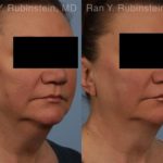 Coolsculpting Elite Before and After Photos in Newburgh, NY, Patient 12419