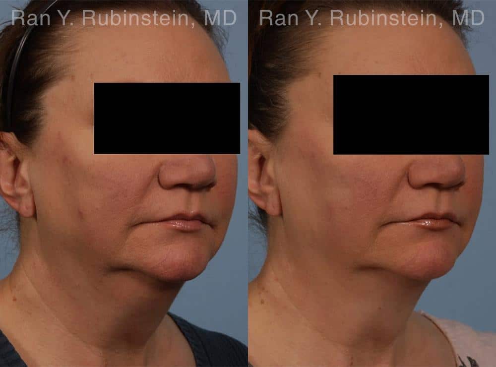 Coolsculpting Elite Before and After Photos in Newburgh, NY, Patient 12419