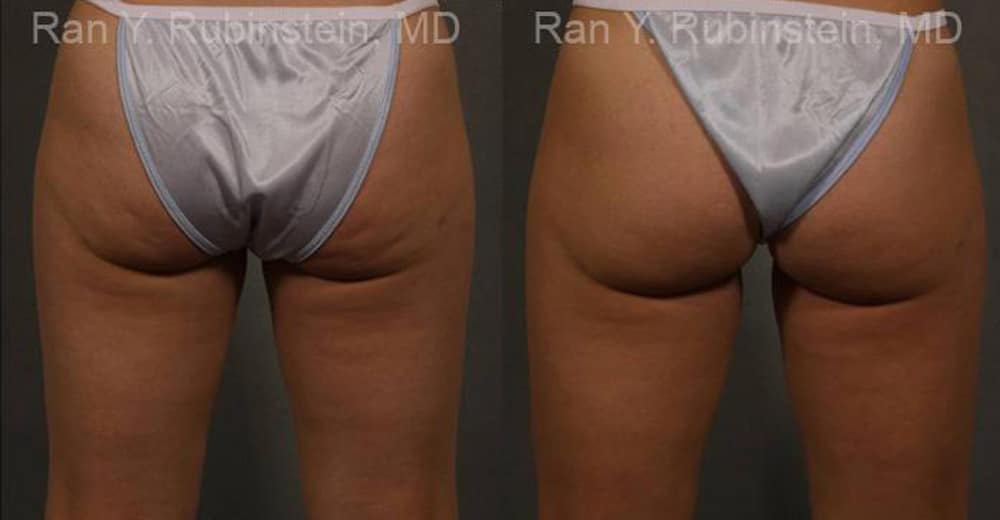 Coolsculpting Elite Before and After Photos in Newburgh, NY, Patient 12424