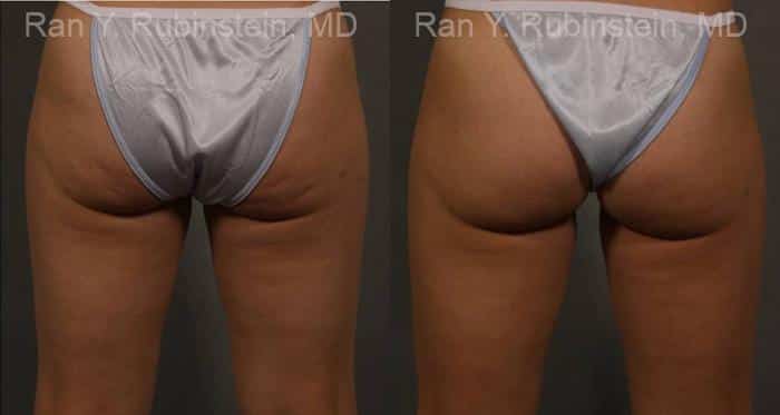 Coolsculpting Elite Before and After Photos in Newburgh, NY, Patient 12424