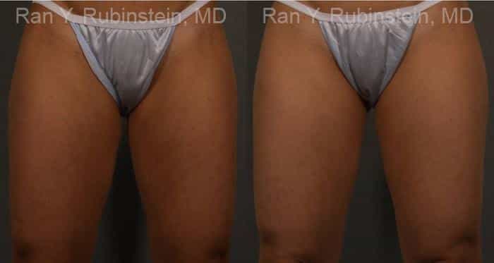 Coolsculpting Elite Before and After Photos in Newburgh, NY, Patient 12424