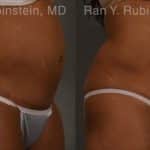 Coolsculpting Elite Before and After Photos in Newburgh, NY, Patient 12429