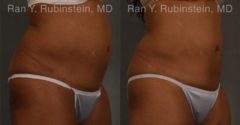 Coolsculpting Elite Before and After Photos in Newburgh, NY, Patient 12429