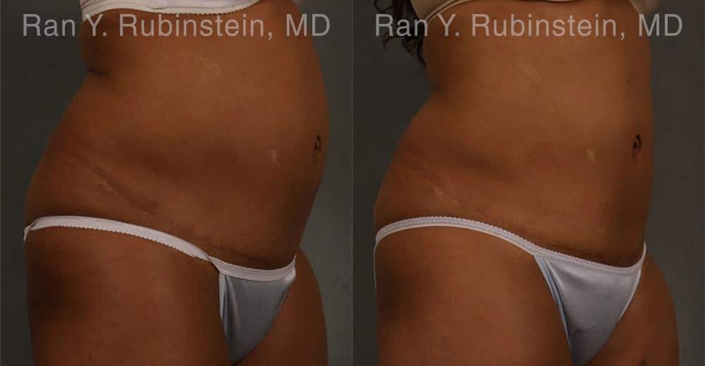 Coolsculpting Elite Before and After Photos in Newburgh, NY, Patient 12429