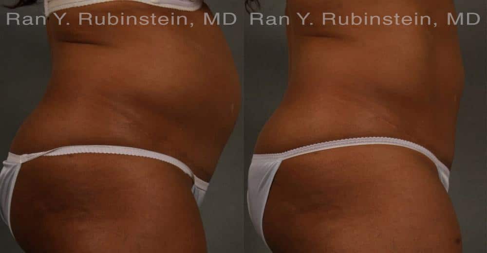 Coolsculpting Elite Before and After Photos in Newburgh, NY, Patient 12429