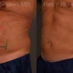 Coolsculpting Elite Before and After Photos in Newburgh, NY, Patient 12434