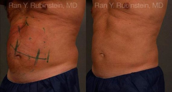 Coolsculpting Elite Before and After Photos in Newburgh, NY, Patient 12434