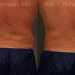 Coolsculpting Elite Before and After Photos in Newburgh, NY, Patient 12434