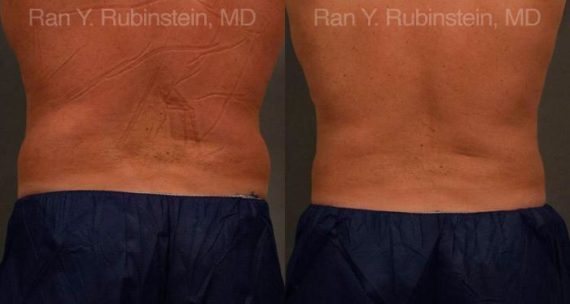 Coolsculpting Elite Before and After Photos in Newburgh, NY, Patient 12434