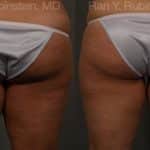 Coolsculpting Elite Before and After Photos in Newburgh, NY, Patient 12439