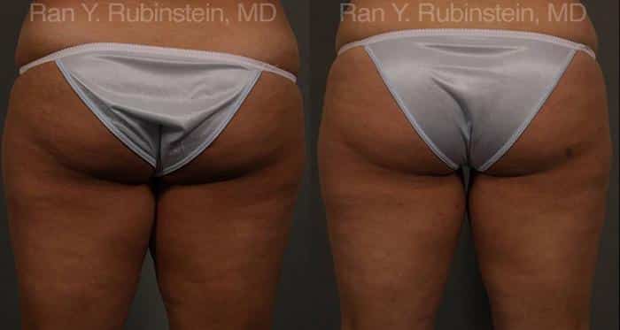 Coolsculpting Elite Before and After Photos in Newburgh, NY, Patient 12439