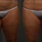 Coolsculpting Elite Before and After Photos in Newburgh, NY, Patient 12439