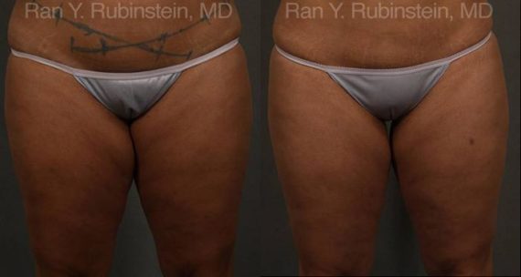 Coolsculpting Elite Before and After Photos in Newburgh, NY, Patient 12439