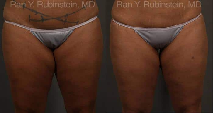 Coolsculpting Elite Before and After Photos in Newburgh, NY, Patient 12439