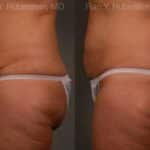 Coolsculpting Elite Before and After Photos in Newburgh, NY, Patient 12444