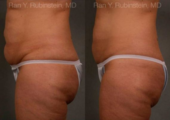 Coolsculpting Elite Before and After Photos in Newburgh, NY, Patient 12444