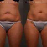 Coolsculpting Elite Before and After Photos in Newburgh, NY, Patient 12444