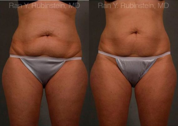 Coolsculpting Elite Before and After Photos in Newburgh, NY, Patient 12444