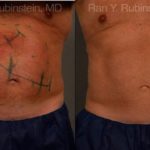 Coolsculpting Elite Before and After Photos in Newburgh, NY, Patient 12449