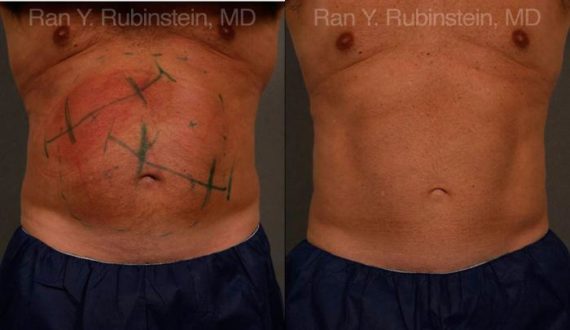 Coolsculpting Elite Before and After Photos in Newburgh, NY, Patient 12449