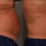 Coolsculpting Elite Before and After Photos in Newburgh, NY, Patient 12449