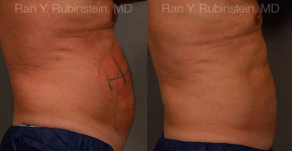 Coolsculpting Elite Before and After Photos in Newburgh, NY, Patient 12449