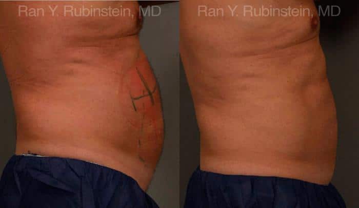 Coolsculpting Elite Before and After Photos in Newburgh, NY, Patient 12449