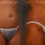 Coolsculpting Elite Before and After Photos in Newburgh, NY, Patient 12454