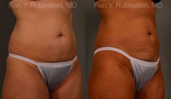 Coolsculpting Elite Before and After Photos in Newburgh, NY, Patient 12454