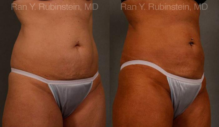 Coolsculpting Before and After Photos in Newburgh, NY, Patient 12454