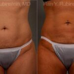 Coolsculpting Before and After Photos in Newburgh, NY, Patient 12454