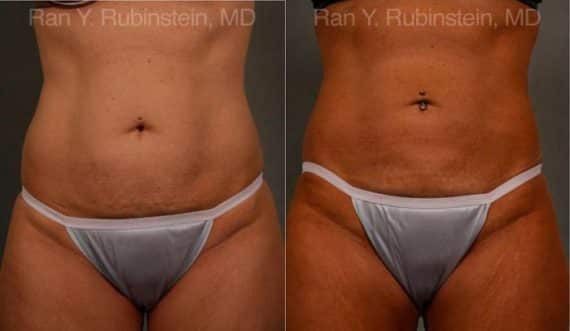 Coolsculpting Elite Before and After Photos in Newburgh, NY, Patient 12454