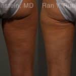 Coolsculpting Elite Before and After Photos in Newburgh, NY, Patient 12459